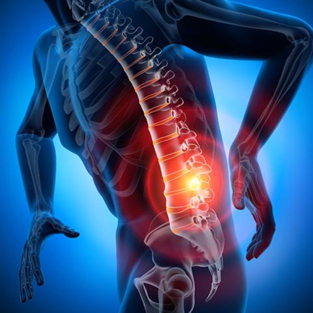 Degeneração da Coluna