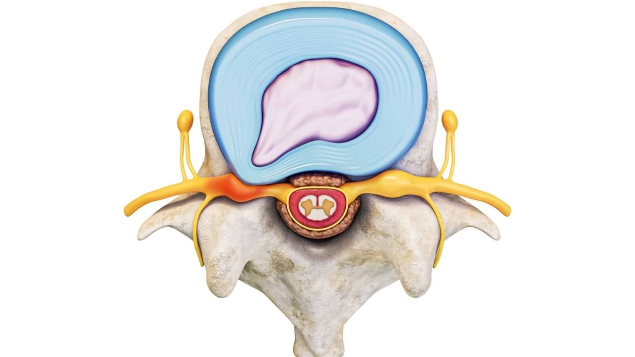 Protrusão Discal