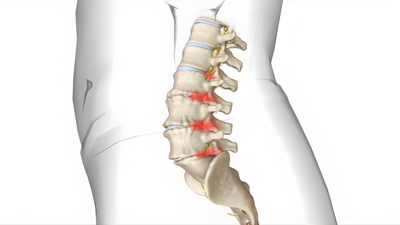 Doença Degenerativa do Disco