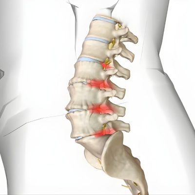 Doença Degenerativa do Disco