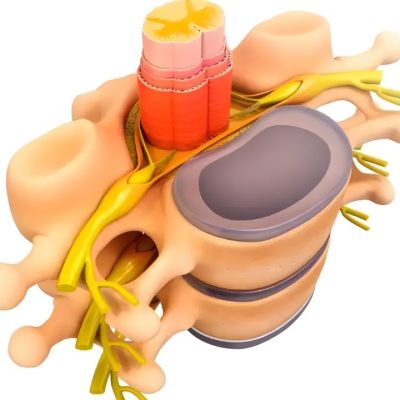 Estenose do Canal Vertebral