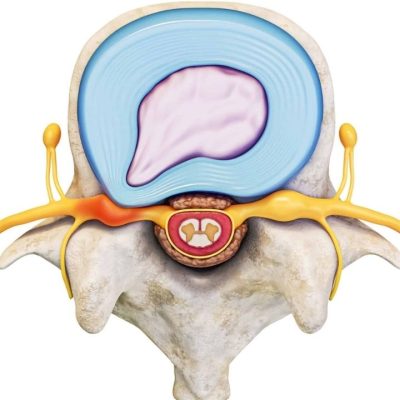 Protrusão Discal